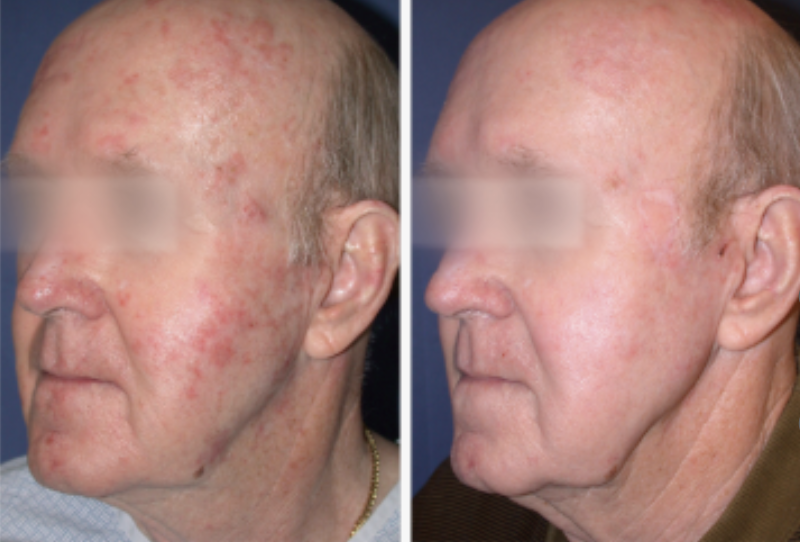 male patient's before and after results after sciton treatment
